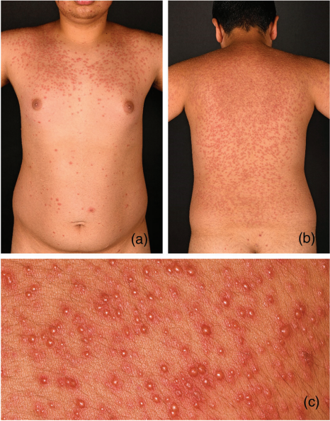 美林资管 孩子游泳回来竟全身皮疹，这种不典型感染症状要警惕！